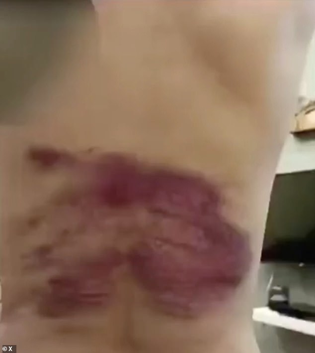 The images show how the woman has bruises all over her back, as well as on the upper part of the back of her thighs.