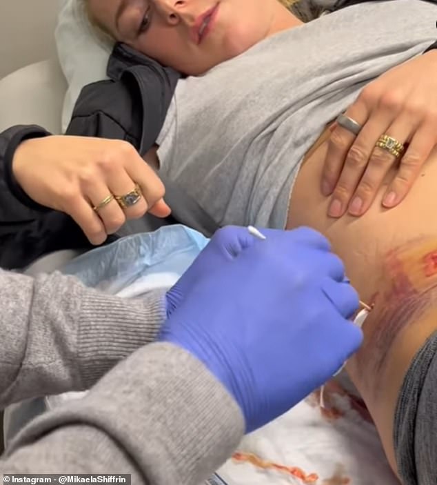 In one video, a nurse shows the American skier how deep the stab wound is in her side