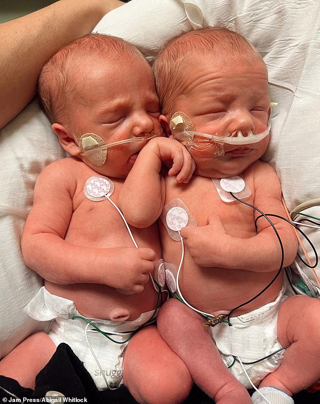 In August 2023, after just 34 weeks, the decision was made to deliver the twins via caesarean section