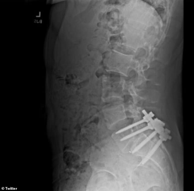 An X-ray appeared to show Mangione's surgery