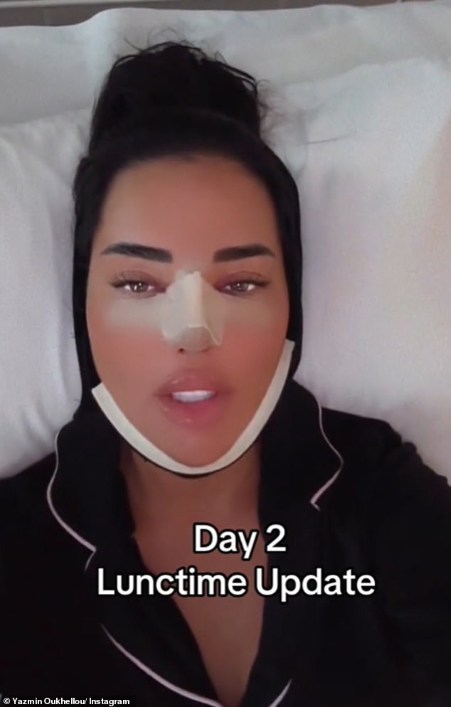 While posing for a selfie in bed, Yazmin was seen with a bandage on her nose and a bandage around her face.