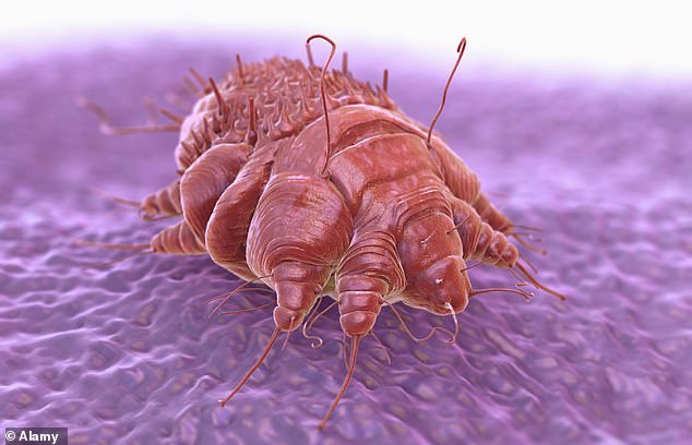 Most commonly associated with the Victorian or Dickensian era, scabies manifests as an intensely itchy rash caused by the saliva, eggs and feces of the parasitic mite Sarcoptes scabiei (pictured).