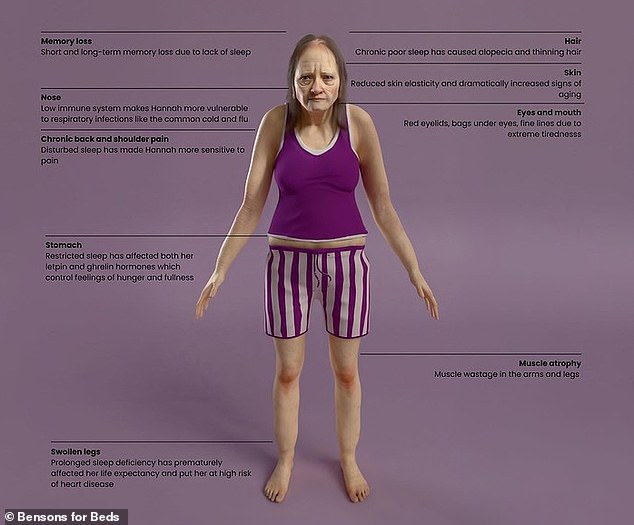 Hannah suffers from chronic back pain, hair loss, sagging skin, swollen legs, droopy eyes, and muscle atrophy (thinning muscle mass) in her arms and legs.