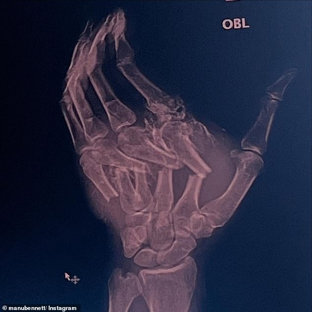 The 55-year-old actor, known for his roles in the Spartacus trilogy and The Hobbit, shared an x-ray of his hand after the 'nasty' accident.