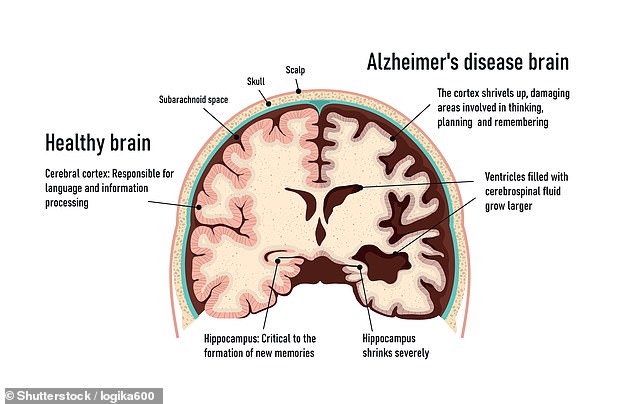 As people age, the amount of healthy tissue in the brain begins to thin naturally. In Alzheimer's disease, this occurs at a much faster rate, causing memory loss, personality changes, and confusion often associated with the disease.