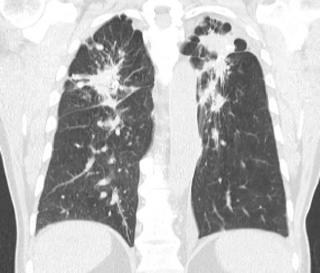 Silicosis appears on a CT scan as small white nodules scattered throughout the lungs. Scan courtesy of radiopaedia.org