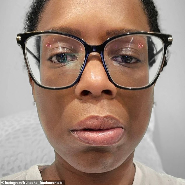 Fruitcake took to Instagram on Tuesday to address a six-week hiatus and revealed that she had been recovering from Bell's palsy, a neurological condition that causes temporary weakness or paralysis in the muscles on one side of the face.