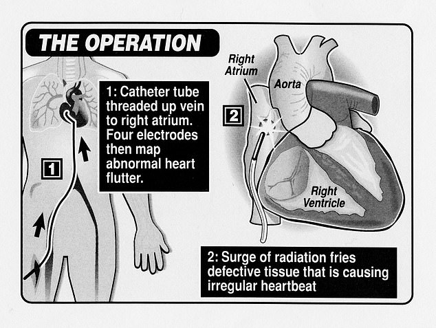 About 4 percent of people with atrial fibrillation have it severe enough to undergo catheter ablation. The procedure involves damaging specific regions of the heart that are diseased so that the entire muscle pumps better.