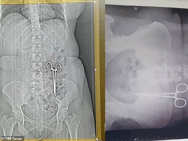 The images above show additional views of Ms Bai's abdomen before the scissors were removed.