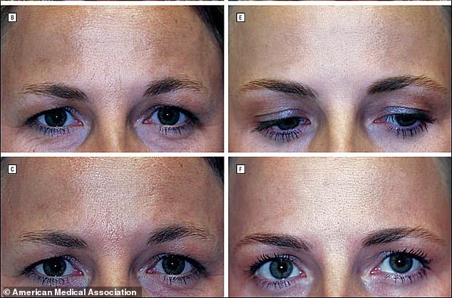 The images show that the twin who received very few injections (images B and C) and the one who received Botox regularly (E and F) had significantly more forehead wrinkles.