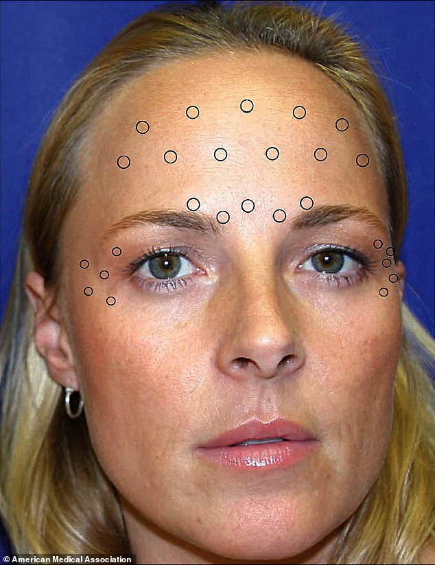 Shown in the photo are the locations where one twin received Botox injections in the forehead, glabellar (between the eyebrows), and crow's feet regions.