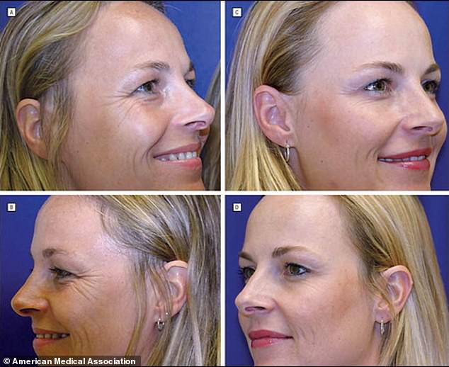 Crow's feet when smiling are more visible in the twin who lets nature take its course (images A and B). The regularly treated twin (images C and D) had much less pronounced crow's feet.