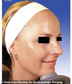 The woman treated with Botox had more superficial wrinkles compared to her sister around the eyes and mouth.