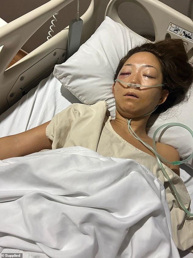 Ms Fukuyama spent five nights in hospital, suffering from a fractured eye socket and head injuries.