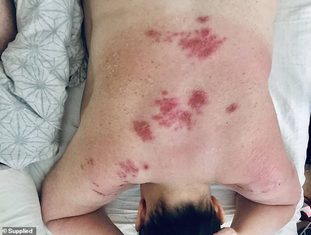 Doctors tried to treat Ms Haines, but nothing worked to relieve the painful red rash that would take over her entire body (pictured). However, everything changed when he moved to the United Kingdom.