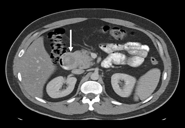 A scan showing the man's tumor highlighted by a white arrow.