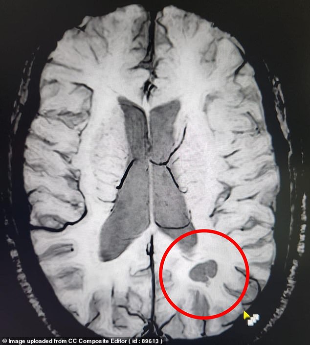 Deep in my frontal cortex, behind where the light hit me, is an implant inside a sac-shaped container (circled). I have no doubt that this is the mother lode of my psychic gifts.