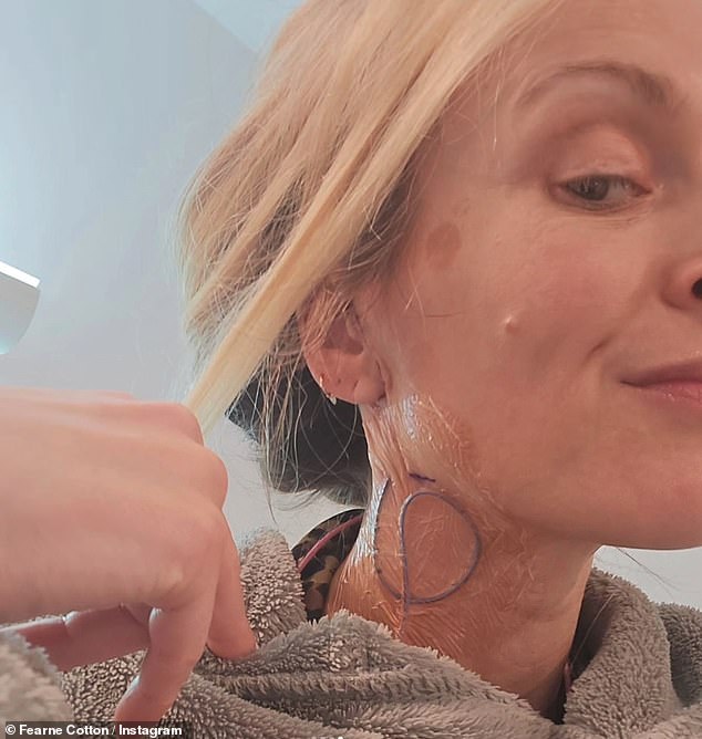 Taking to Instagram on Saturday, Fearne shared snaps of her scar as it improved after surgery.