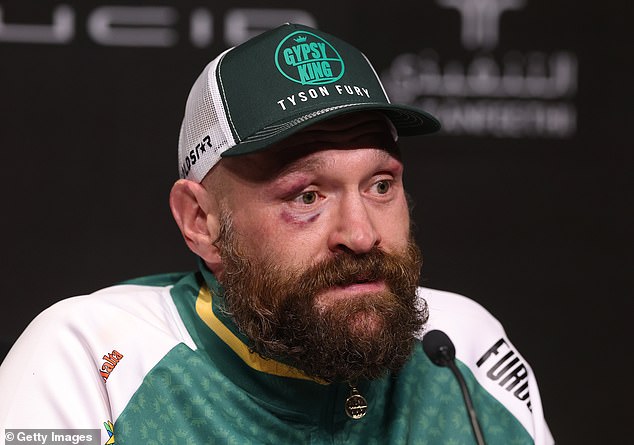 After the fight, Fury showed off his bruised right eye as a result of Usyk's powerful punches.