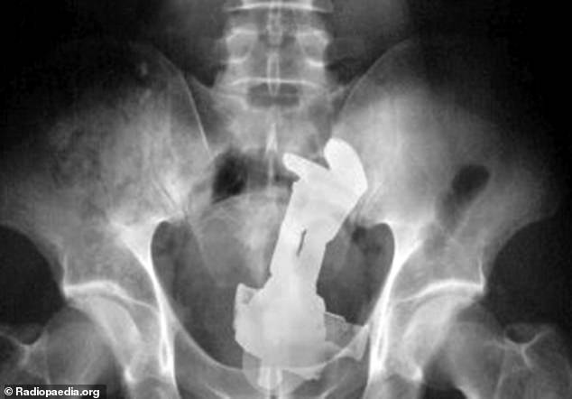 Doctors also told DailyMail.com about previous situations where people arrived at A&E with Buzz Lightyear stuck in their butt.