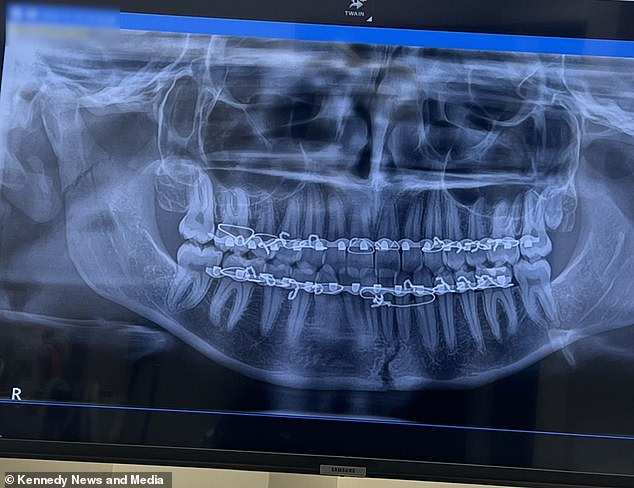 An ambulance took Wasim to hospital where he had an x-ray and CT scan, and was 'shocked' to discover he had suffered two fractures to his jaw.