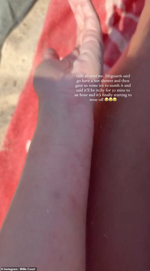 Posting on her Instagram Stories, Millie revealed how she found a blue jellyfish wrapped around her neck, in her hair, with tentacles all over her stomach, causing a rash all over her body.