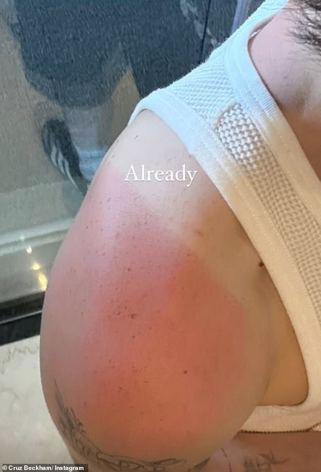 Taking to Instagram after his day in Rio, where temperatures currently reach 25 degrees, Cruz revealed his sunburn with the accompanying comment: 