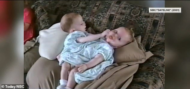 She and her twin sister Kathleen were joined from the sternum to the pelvis when they were born in 2000. The sisters, who each had one leg, shared several internal organs and a fused third leg.