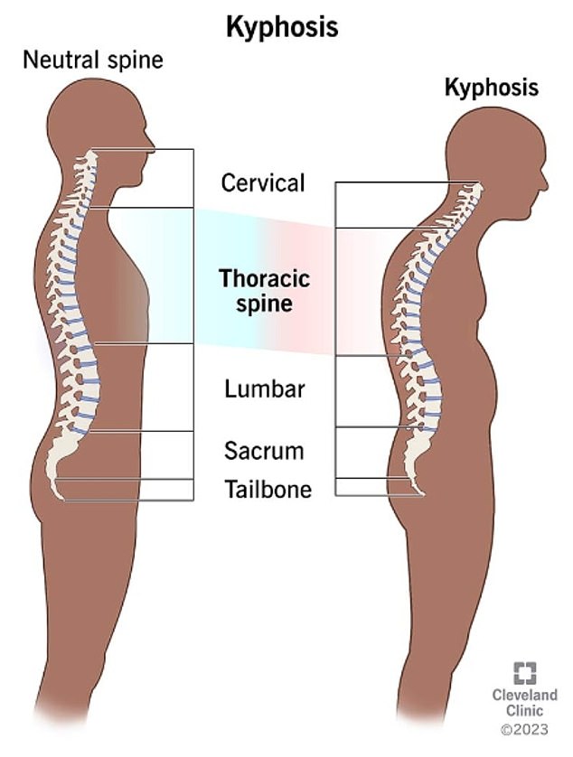 Kyphosis, also called round or humpback, affects more than 3 million people a year in the US.