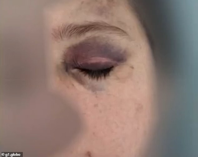 The woman suffered a bruise on her eye after a member of the São Paulo Military Police hit her while trying to arrest her in front of her home in October.