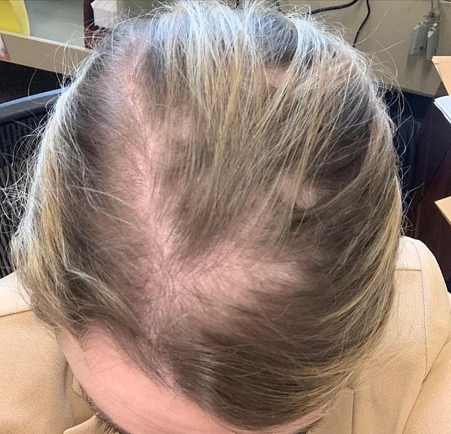 The woman also shared this image in August 2021, which is when she said she was at the peak of her hair loss while taking the drug.