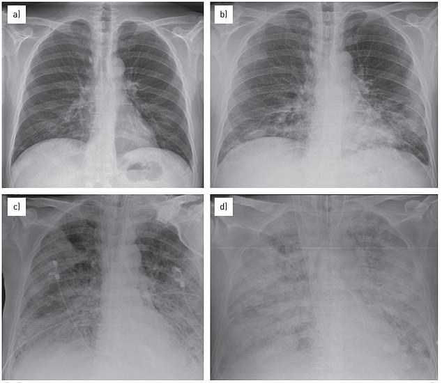 Pneumonia causes white spots or opaque areas to appear in the lungs. The previous patient was a 57-year-old man in 2014.