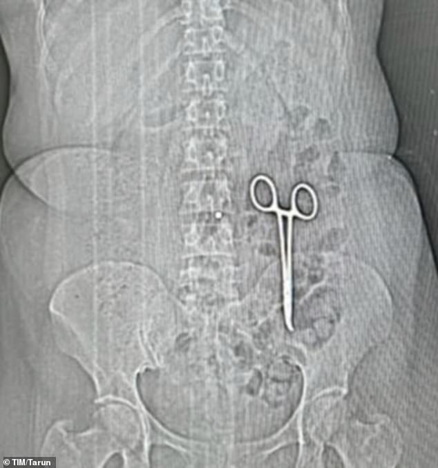 The CT scan above shows the scissors in Ms. Bai's left paracolic canal, a narrow space in the abdomen that runs along the descending colon. He suffered no complications once they were removed.