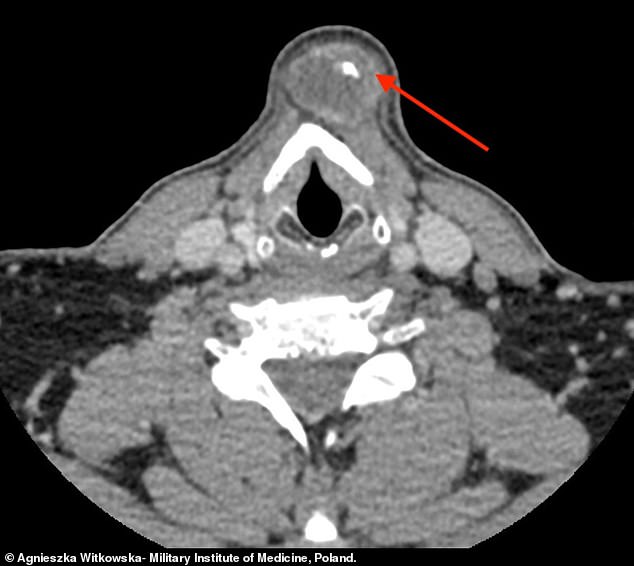 The arrow shows the lump in the throat of the 46-year-old patient. Doctors decided to remove it before suspecting it might have cancer.