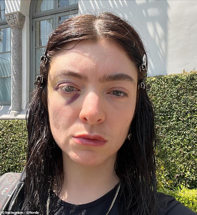 Last month, Lorde sparked concern on Monday after she shared a series of photos on Instagram, revealing a black eye.