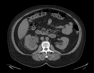 This CT scan was taken after the kidney stones ruptured.