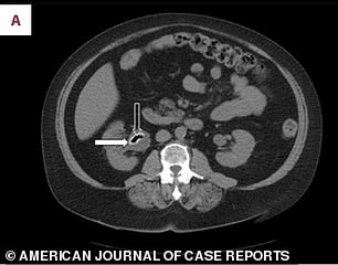 This CT scan shows gas-filled stones in the woman's kidney area.