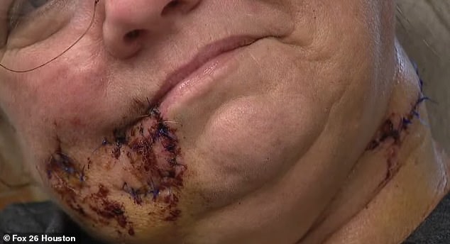 A pack of wild dogs tore off part of his right cheek, leaving his lip hanging from his face.