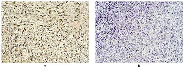 Above are findings from the analysis of the patient's tumor (left) and the surgeon's tumor (right). They revealed that the two men had 'identical' tumors