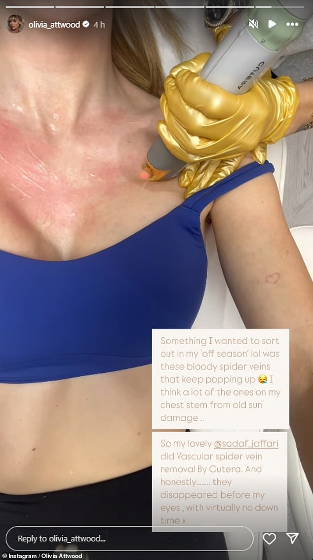 Olivia shared that one of the treatments she opted to undergo was spider vein removal, a laser treatment that helps eliminate prominent veins.