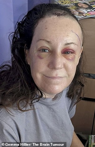 The teacher (pictured after surgery) who thought she had good vision was referred to an eye clinic for further testing and in November 2023 had an MRI, which revealed she had a non-cancerous brain tumor.