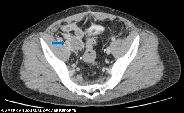 In this CT scan performed after the patient was first discharged, doctors found a blood clot in the left iliac artery, marked by the blue arrow. They also found a blood clot that had traveled to the man's lungs.