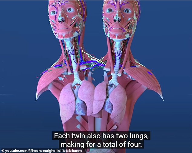 Each twin has two lungs (two partially fused), two stomachs, two gallbladders, three kidneys, a liver, a small intestine, a large intestine, a pelvis, a bladder, and a set of reproductive organs.