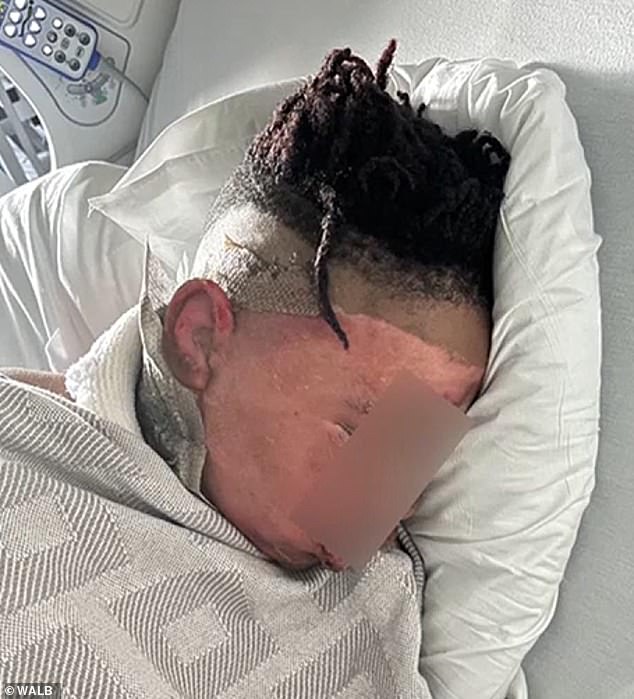 “He's numb about it,” a family member told WALB-10 this week, when asked if the boy was “angry or sad” about the ordeal. He is currently recovering at home after successful surgery, they said