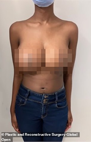 The anonymous woman is shown above after receiving breast reduction surgery. You are considering further procedures to return to your normal cup size.