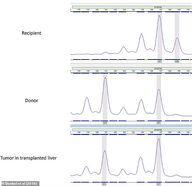 The above tables show that the genetic composition of the tumor in the man's transplanted liver is the same as that of the donor.