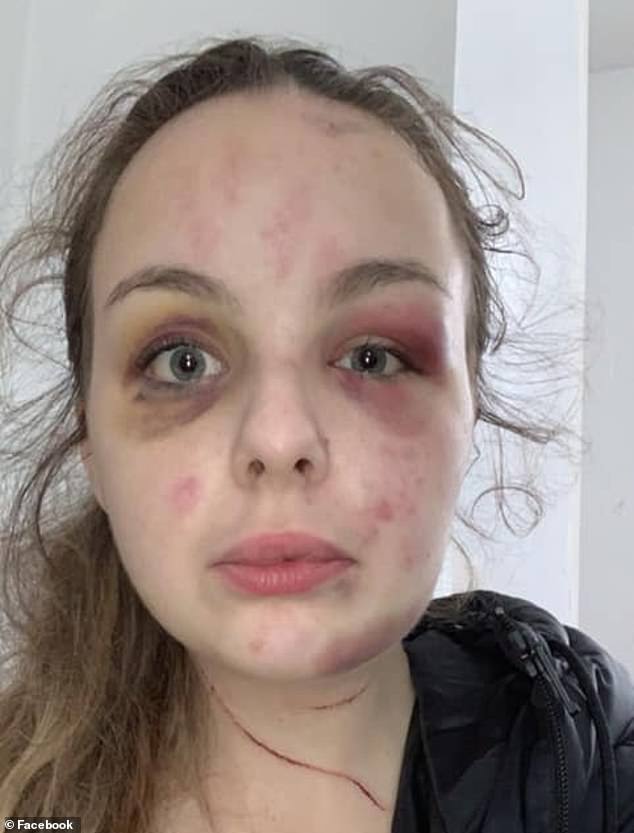 Williams sparked outrage after gruesome images of her bruised face and false allegations of abuse by an Asian grooming gang sparked far-right protests.