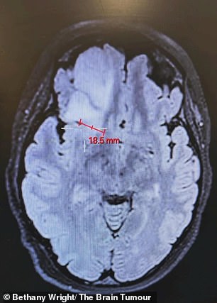 She was worried she had preeclampsia, a pregnancy complication that causes high blood pressure, but a CT scan showed a mass in her brain (pictured).