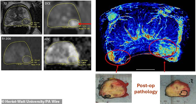 MRI images (left) and new super-resolution images (right) demonstrate undetected tumor