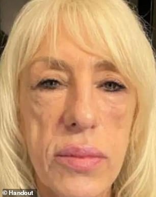 Andrea said she has been scared both mentally and physically. He suffers from facial pain (pictured with scars after treatment) and has been diagnosed with post-traumatic stress disorder.